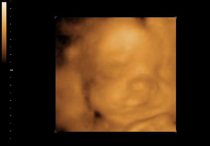 3D ultrasound image at 28 weeks